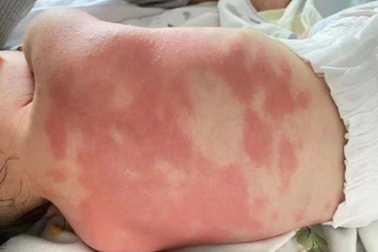 海鲜过敏红斑图 海鲜过敏红斑图