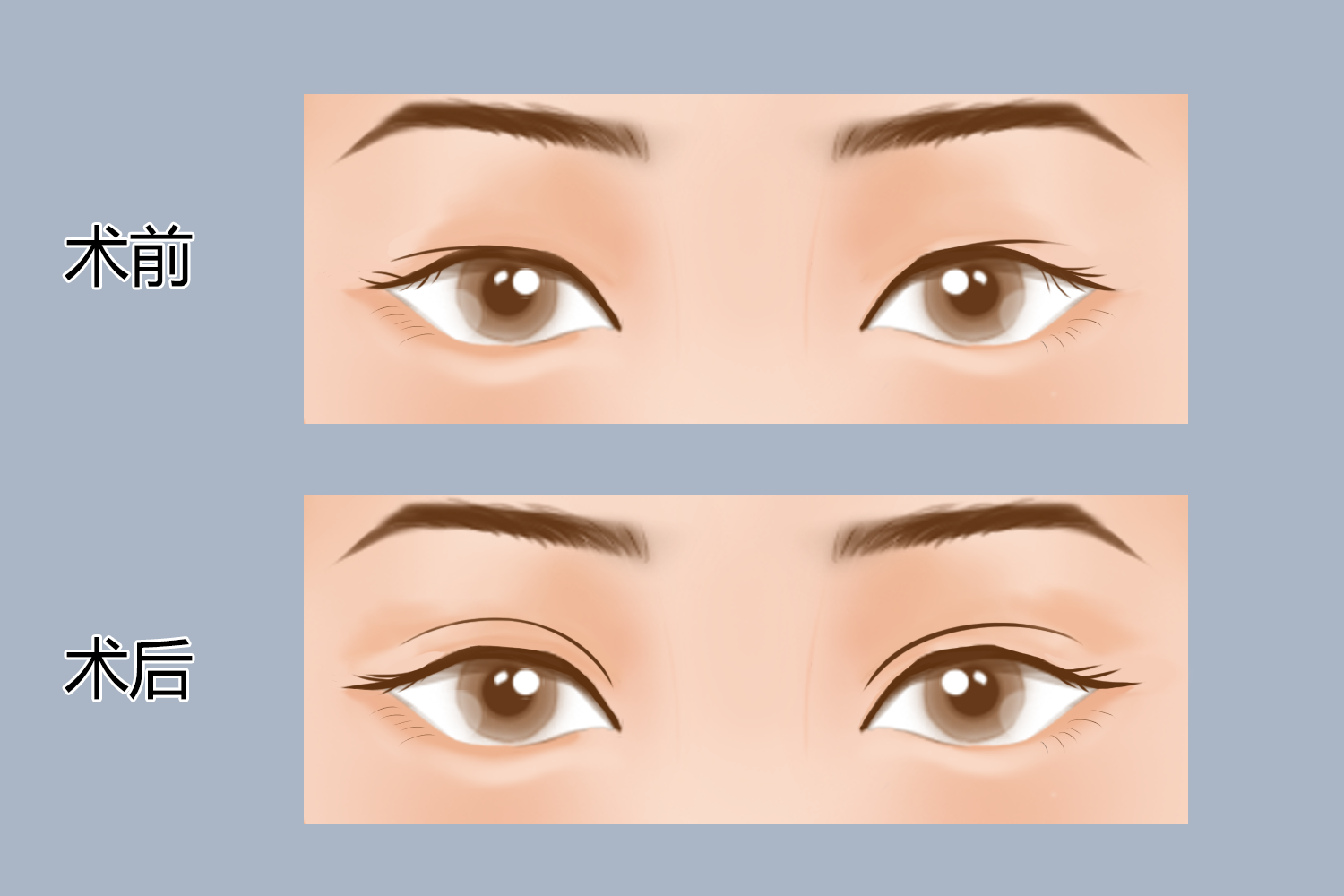 重睑成形术前后对比图