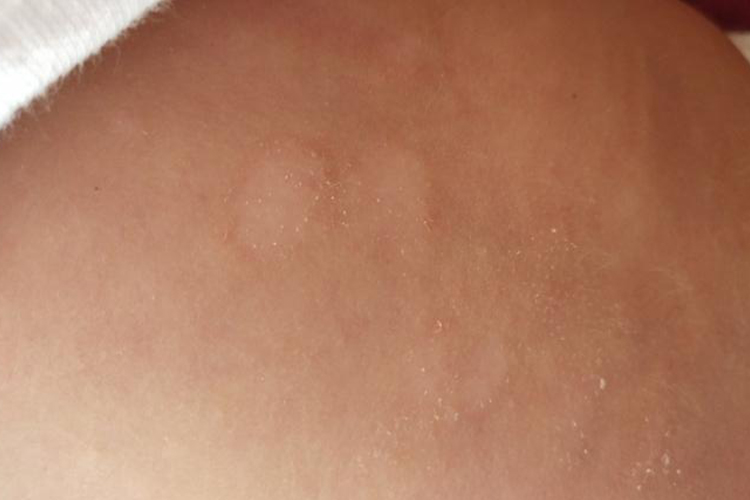 宝宝后背晶形粟粒疹图