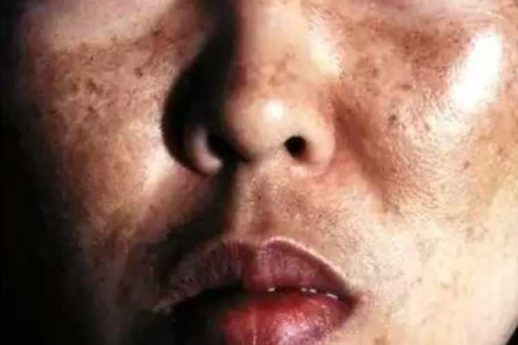 血色病皮肤颜色加深图