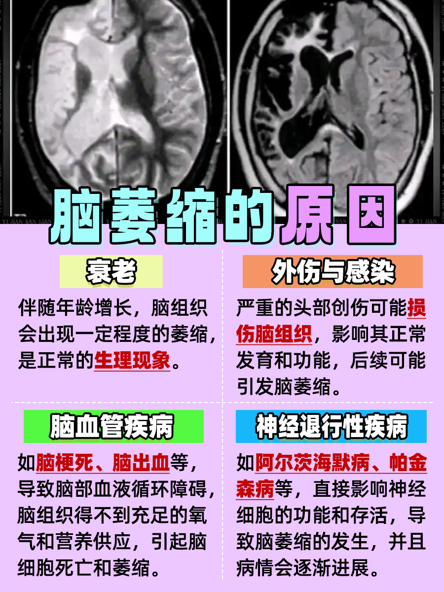 六十多岁CT脑萎缩，你不知道的那些事！