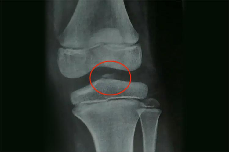 左胫骨髁间隆突骨折图 左胫骨髁间隆突骨折图