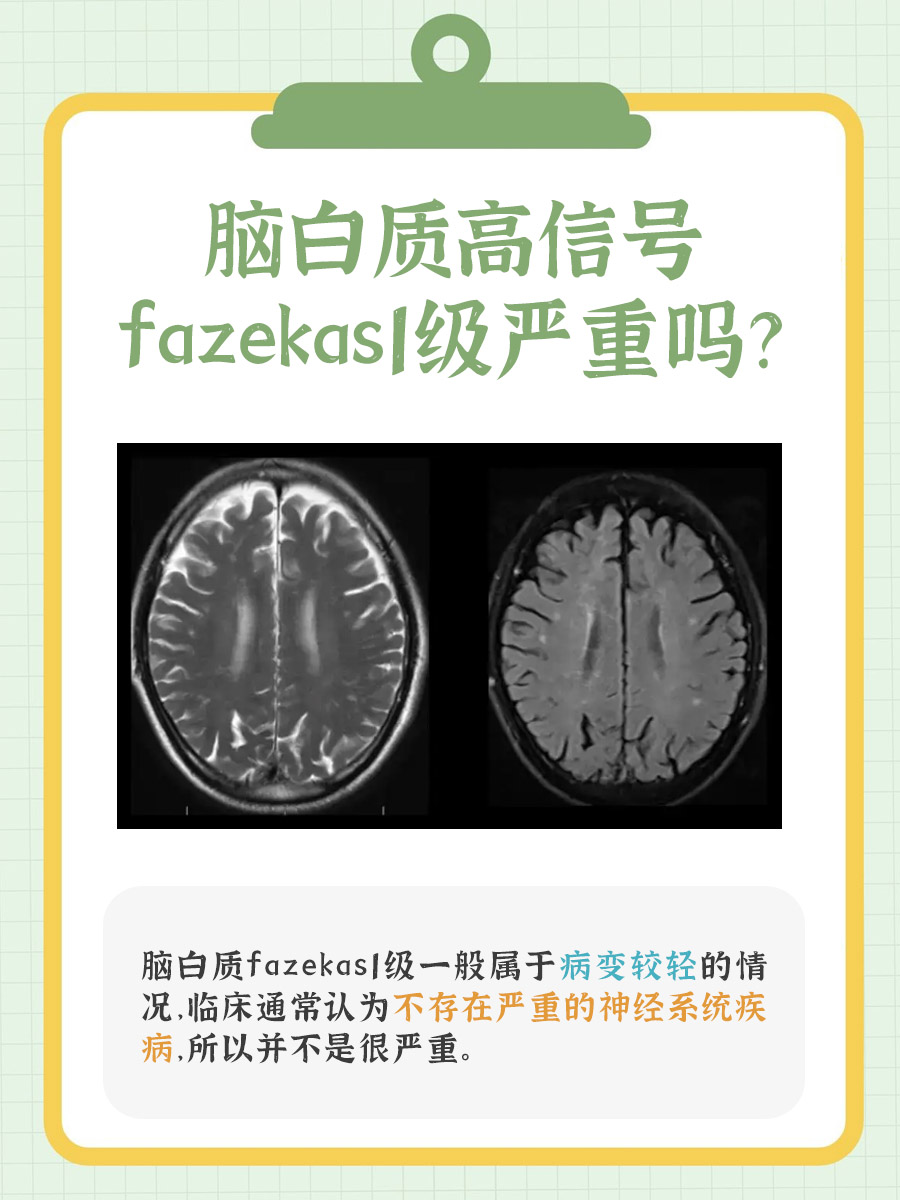 脑白质高信号fazekas1级，严重与否？