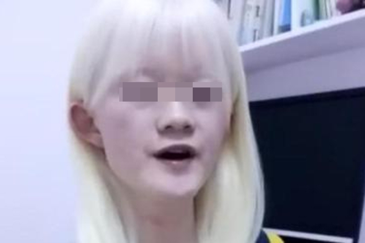 眼皮肤白化病图