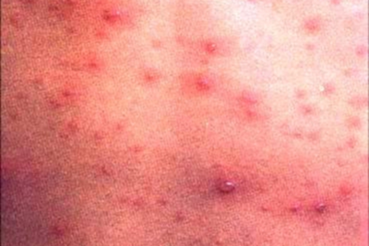 中毒型猩红热胸部有多个红疹子图