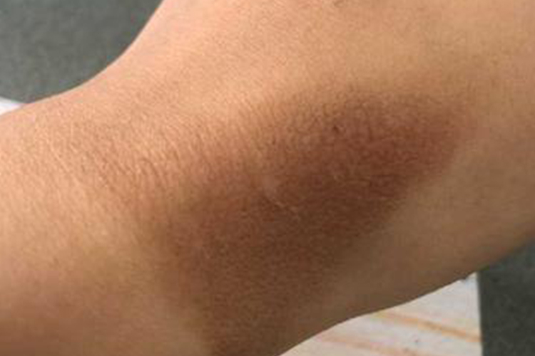 轻度烫伤后黑印图