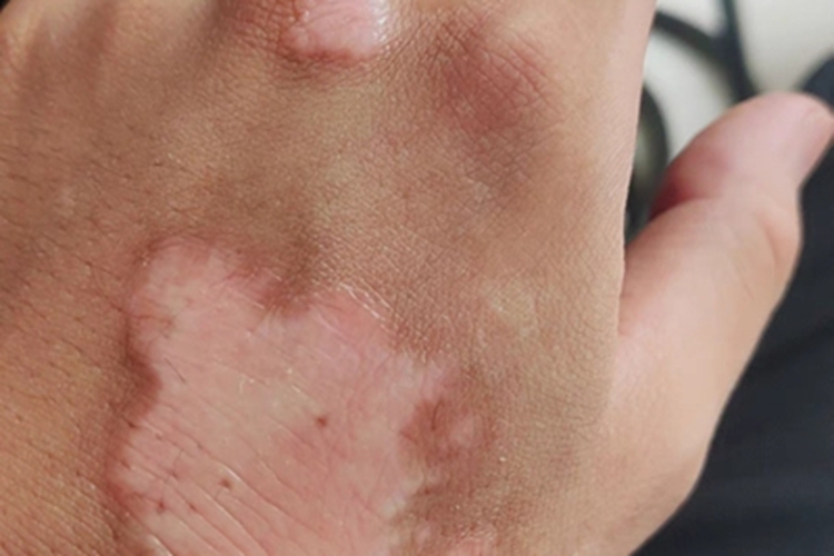 非节段型白癜风手背斑图