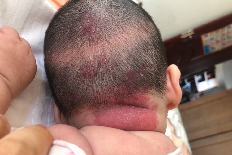 宝宝后脑勺鹤吻痕图