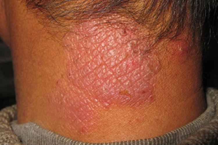 皮肤过敏红肿后颈症状图 皮肤过敏红肿后颈症状图