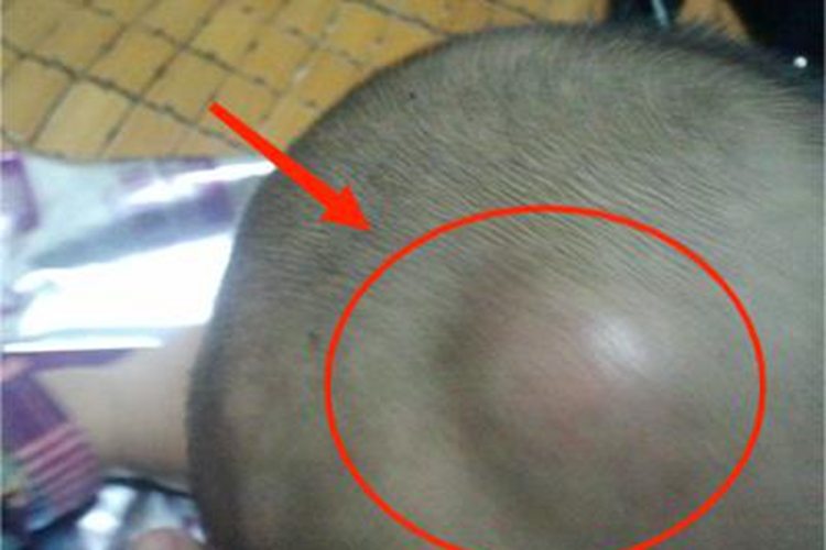 皮下血肿头部大包图