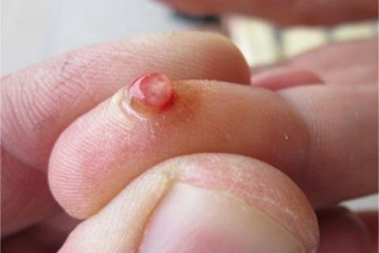 肉芽肿型血管瘤手指上有疙瘩图