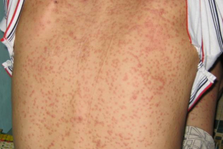 马拉色菌毛囊炎背部有疙瘩图 马拉色菌毛囊炎背部有疙瘩图