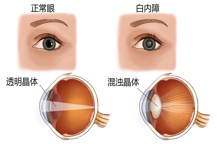 白内障图片