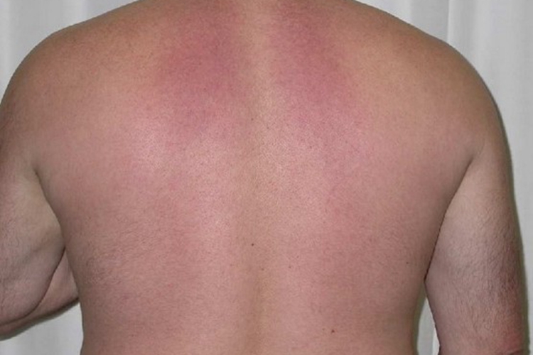 硬肿病背部红肿图 硬肿病背部红肿图