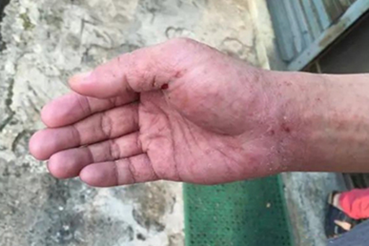 结痂性疥疮血痂图