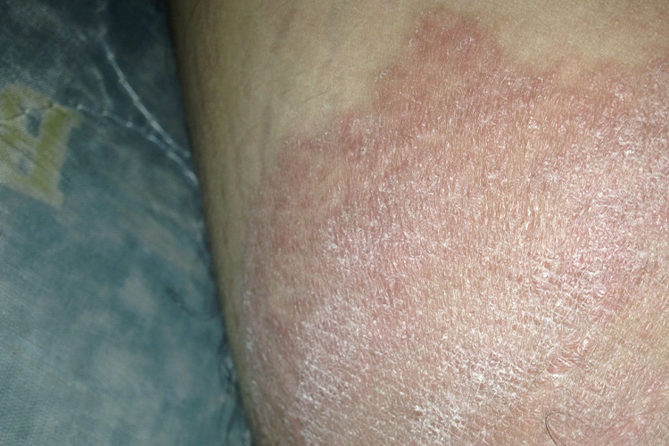 慢性湿疹苔藓样变图