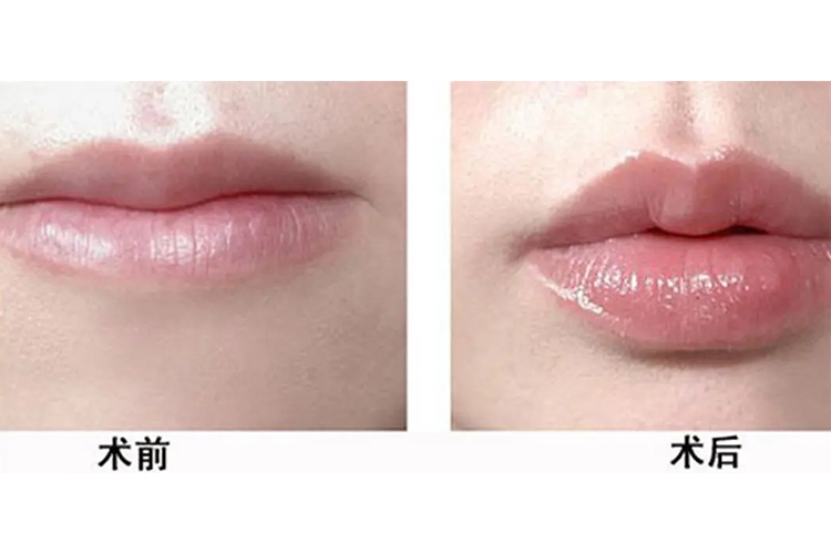 打唇珠前后图 打唇珠前后图