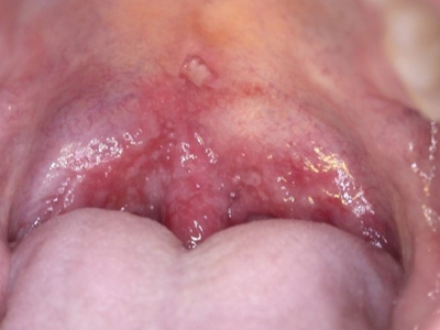 二期口腔梅毒口腔上面长白色小斑块图.jpg