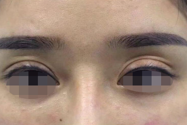 双眼皮失败的八种图片_有来医生