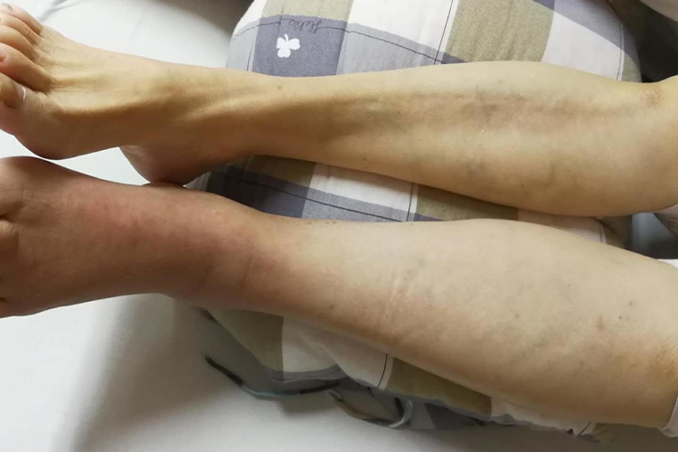 腿上有血栓图 腿上有血栓图