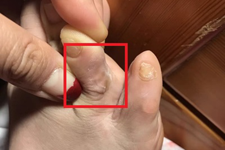 疣脚趾缝皮肤增厚图