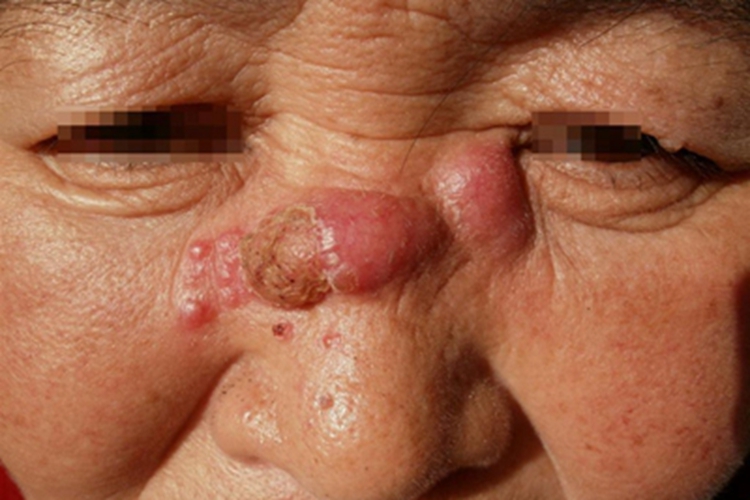 播散型皮肤型孢子丝菌病结节图