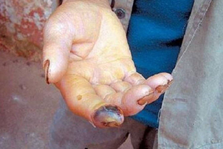 毒蛇咬伤食指尖发黑坏死图 毒蛇咬伤食指尖发黑坏死图