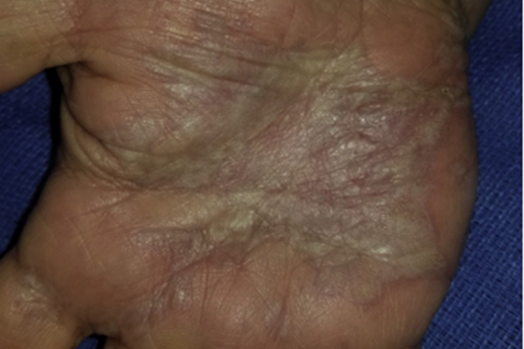 硬化萎缩性苔藓皮肤颜色变浅图