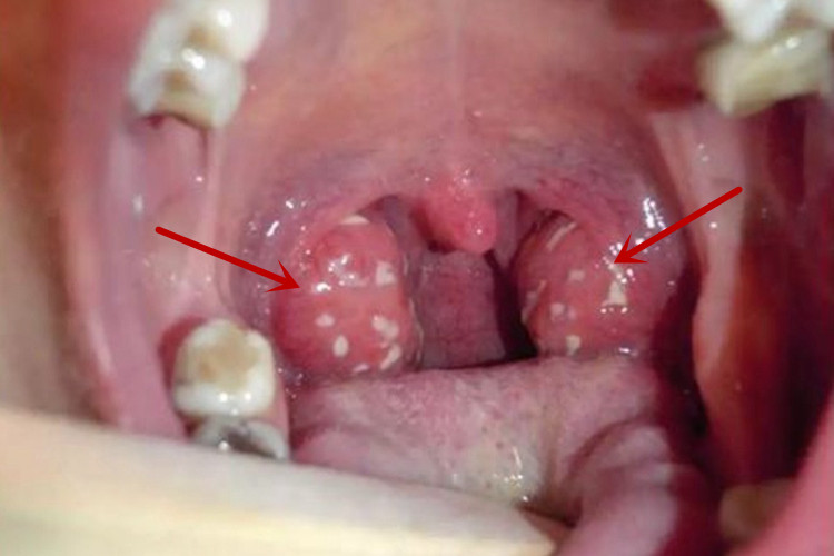 急性扁桃体炎图 急性扁桃体炎图