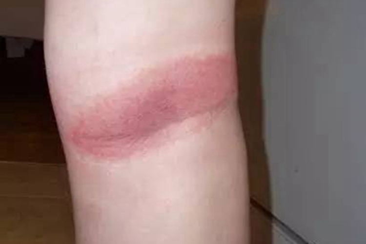 慢性游走性红斑症状图