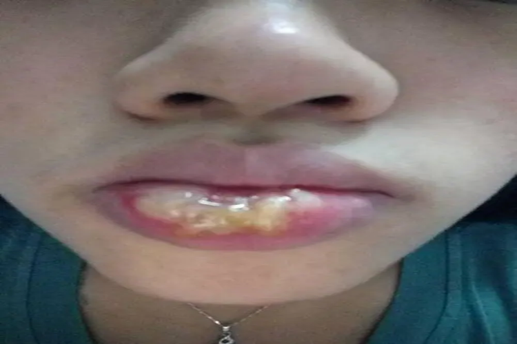 嘴巴过敏嘴唇脓疱图 嘴巴过敏嘴唇脓疱图