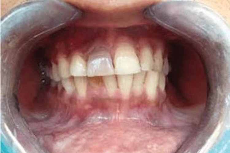 根尖囊肿牙齿变色图