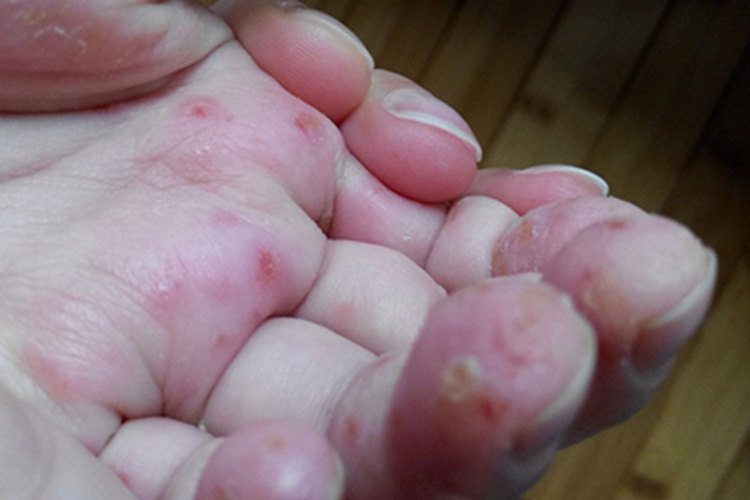 汗疱疹手部水疱图
