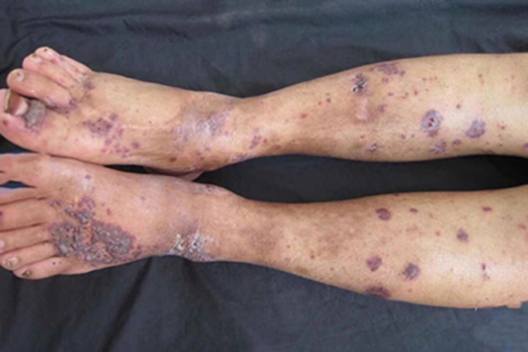 变应性皮肤血管炎脚背紫斑图