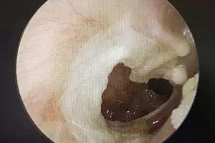 慢性化脓性中耳炎化脓图 慢性化脓性中耳炎化脓图