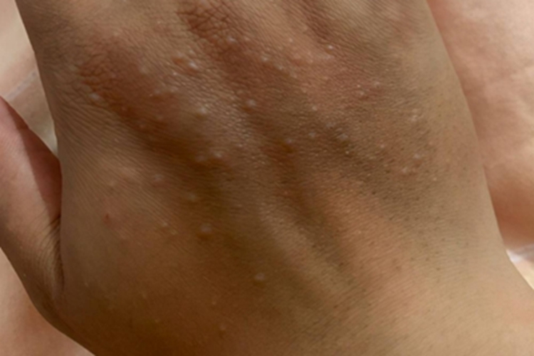 肢端持续性丘疹性黏蛋白病图