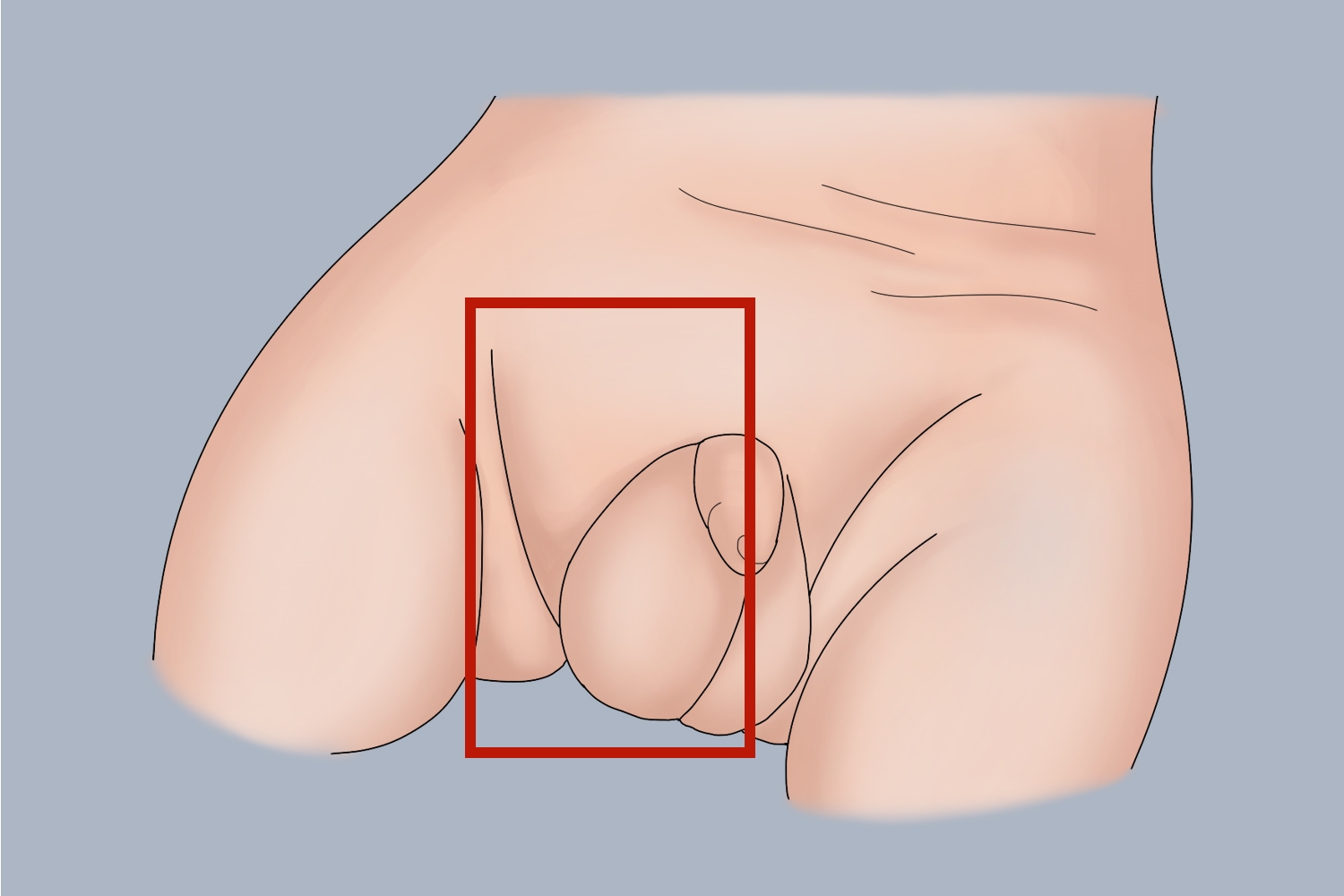 腹股沟区包块图