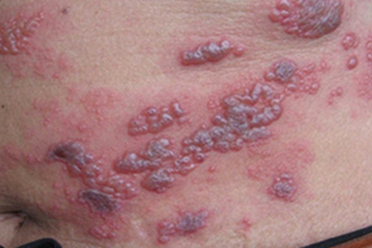 艾滋病感染性皮肤损害症状图