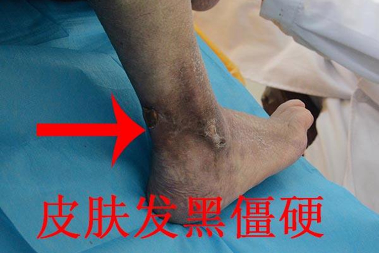 糖尿病足病变症状图