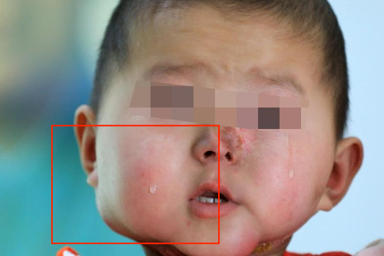 头部横纹肌肉瘤早期图 头部横纹肌肉瘤早期图