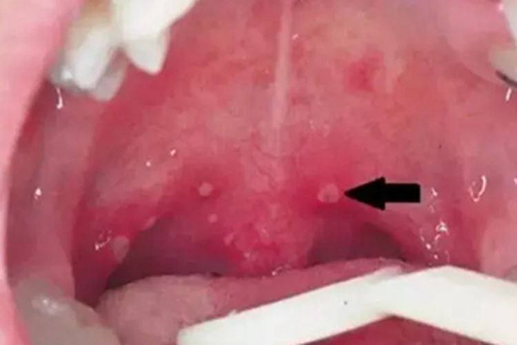 急性疱疹性咽峡炎小水疱图