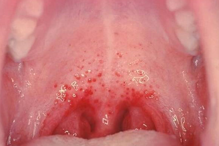 疱疹性咽峡炎丘疹图