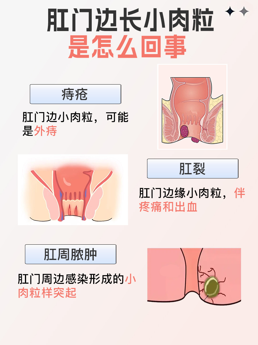 肛门边长小肉粒,怎么回事?专家为你解答