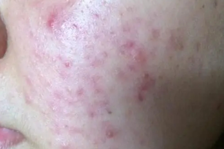 鼻红粒病脸上有小丘疹图