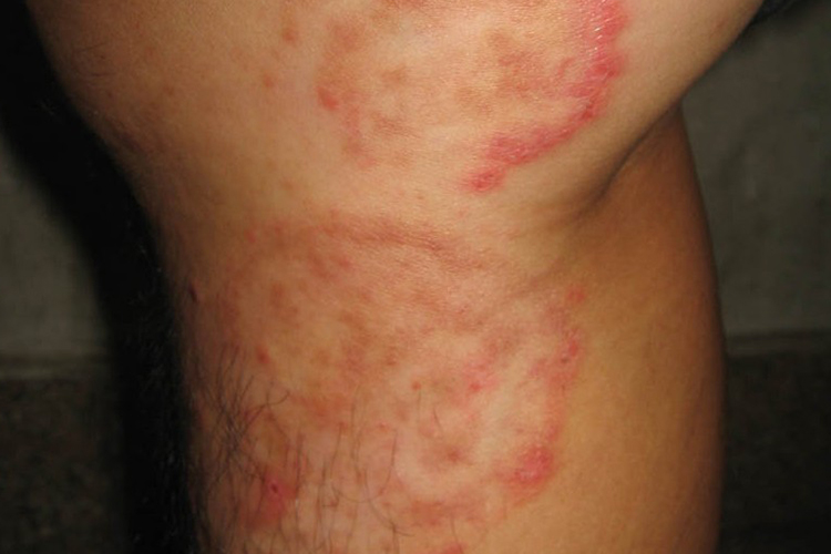 体癣初期环形水疱图