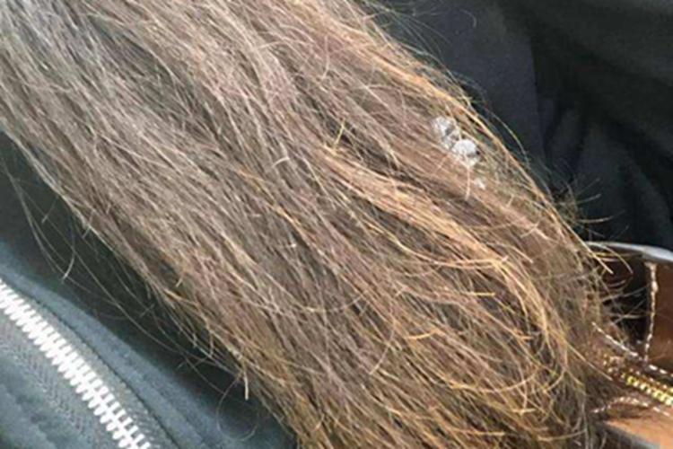 缺铁性贫血头发很干燥图