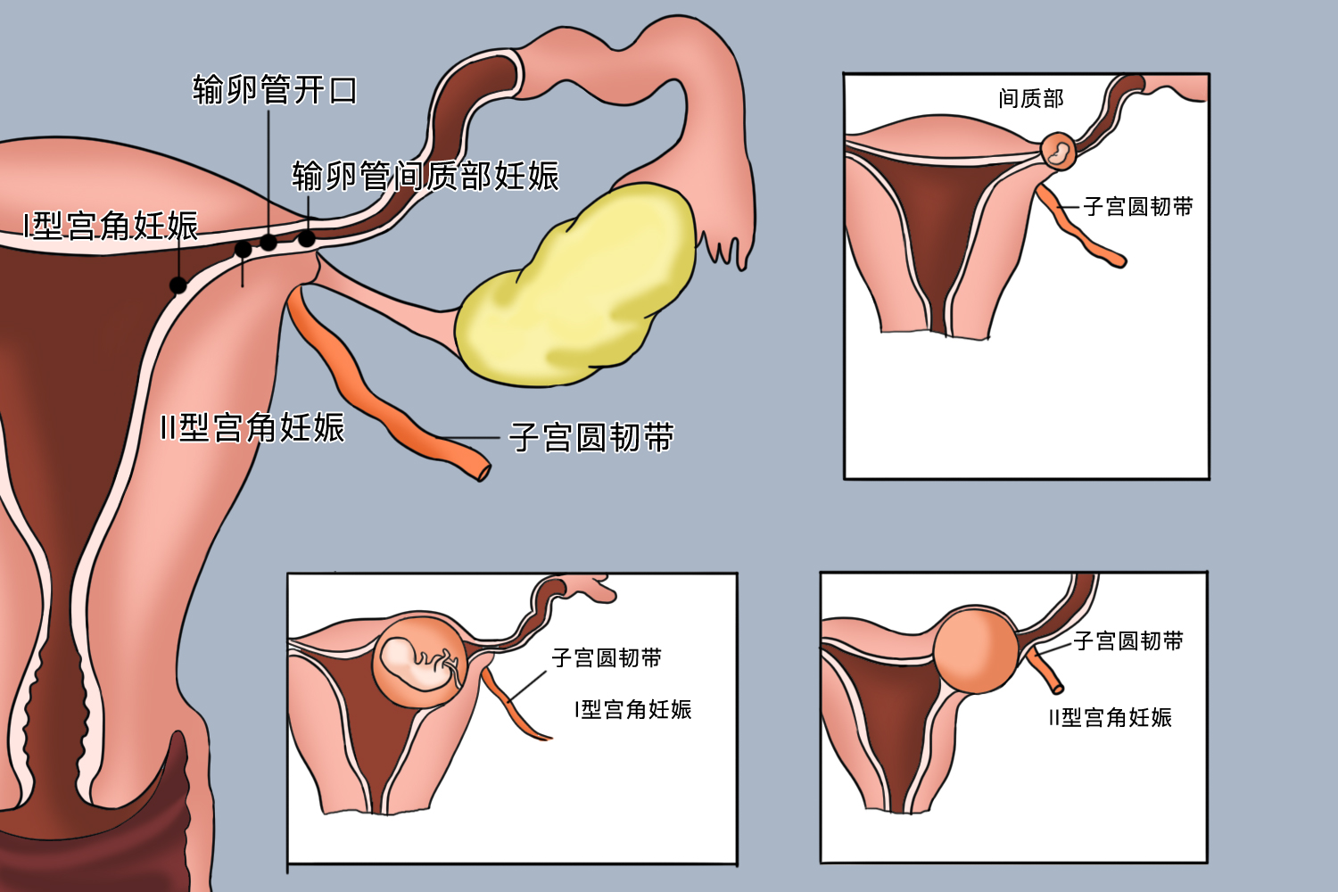 间质部妊娠和宫角妊娠位置图