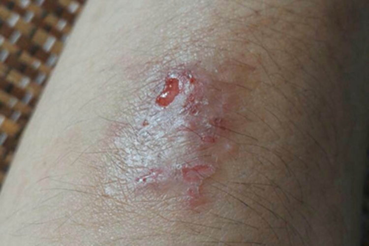 革螨皮炎胳膊渗液图 革螨皮炎胳膊渗液图