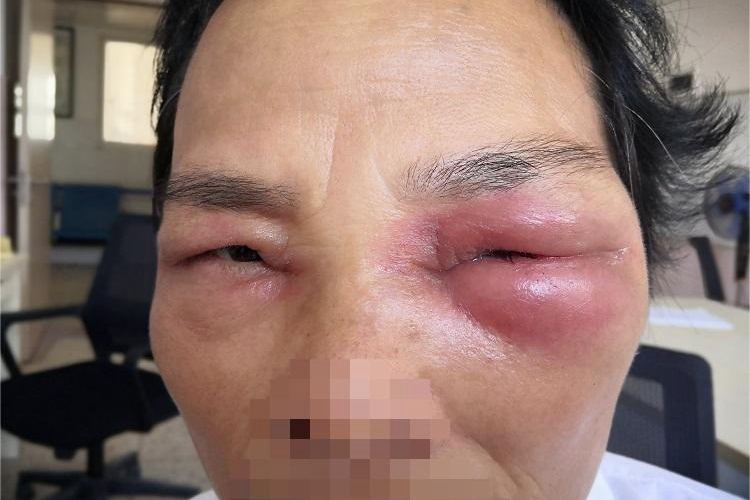 眶蜂窝织炎眼睑充血图 眶蜂窝织炎眼睑充血图