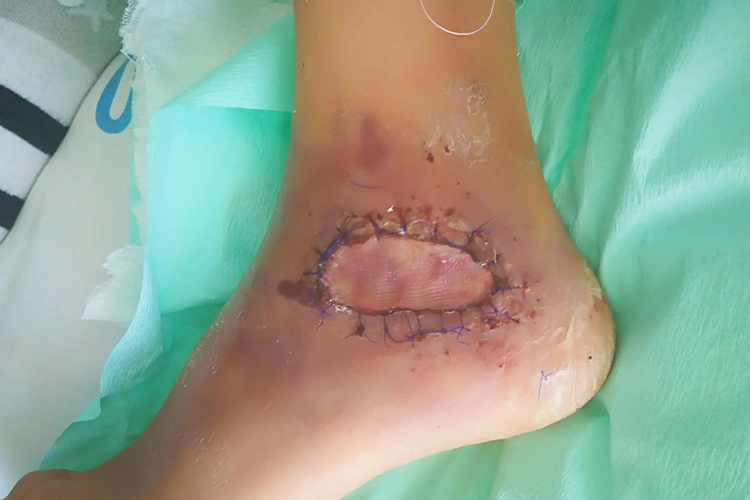 植皮术后图 植皮术后图